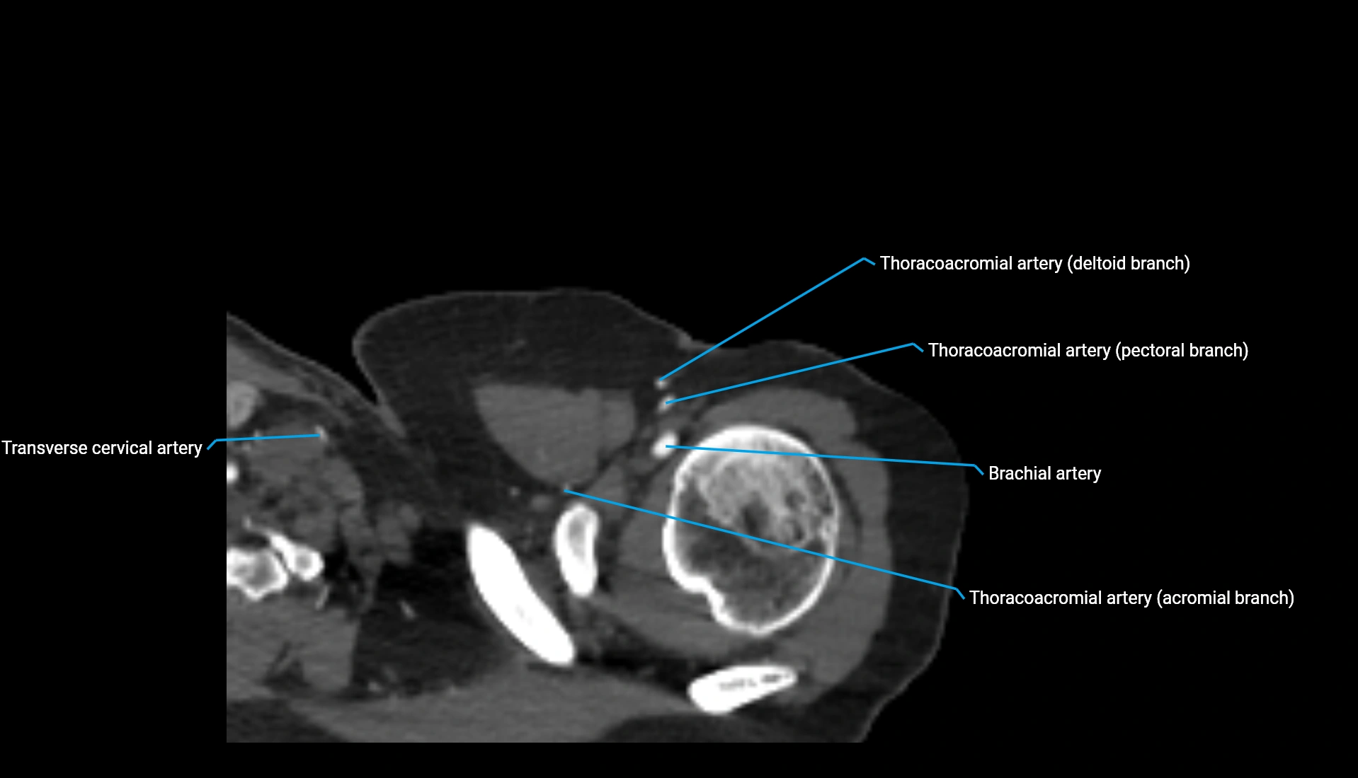 CTA upper limb axial cross sectional anatomy labelled image 323 (1).webp